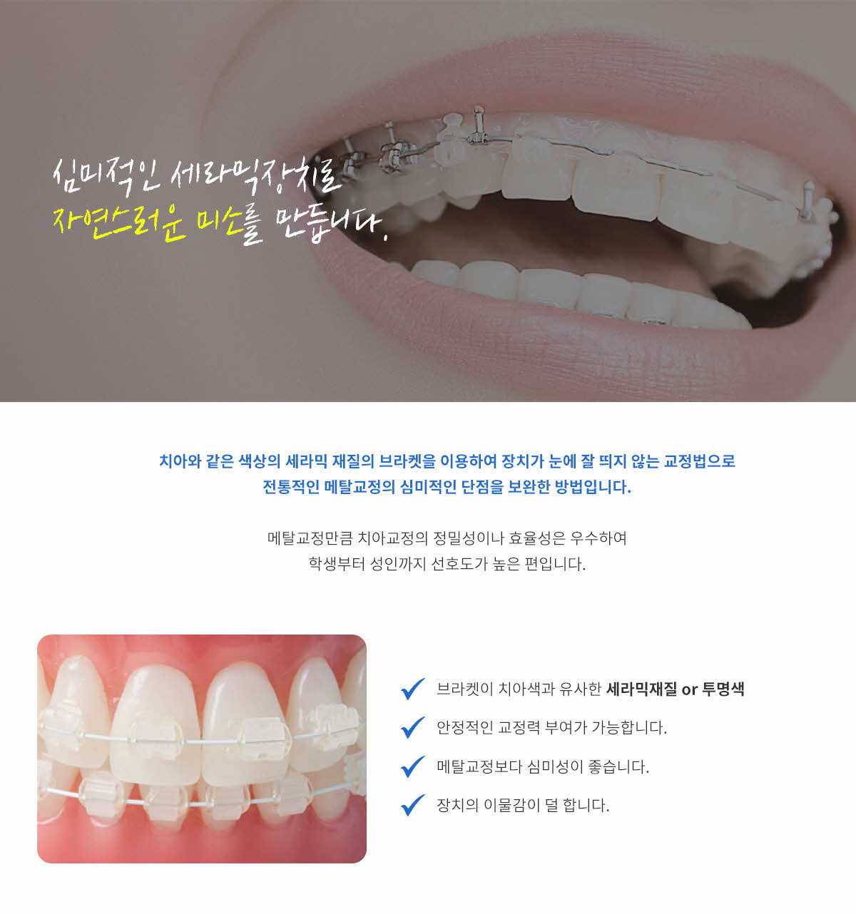 심미적인 세라믹장치로 자연스러운 미소를 만듭니다. - 세라믹 교정장치를 치아에 부착한 모습 이미지, 치아색 세라믹 브라켓 장점 및 특징 안내