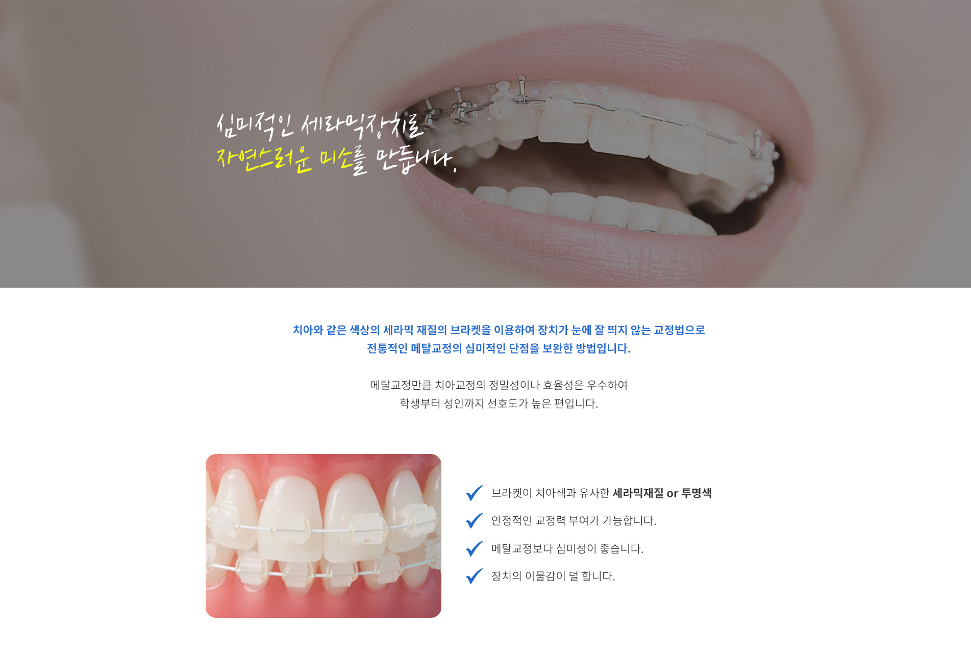 심미적인 세라믹장치로 자연스러운 미소를 만듭니다. - 세라믹 교정장치를 치아에 부착한 모습 이미지, 치아색 세라믹 브라켓 장점 및 특징 안내