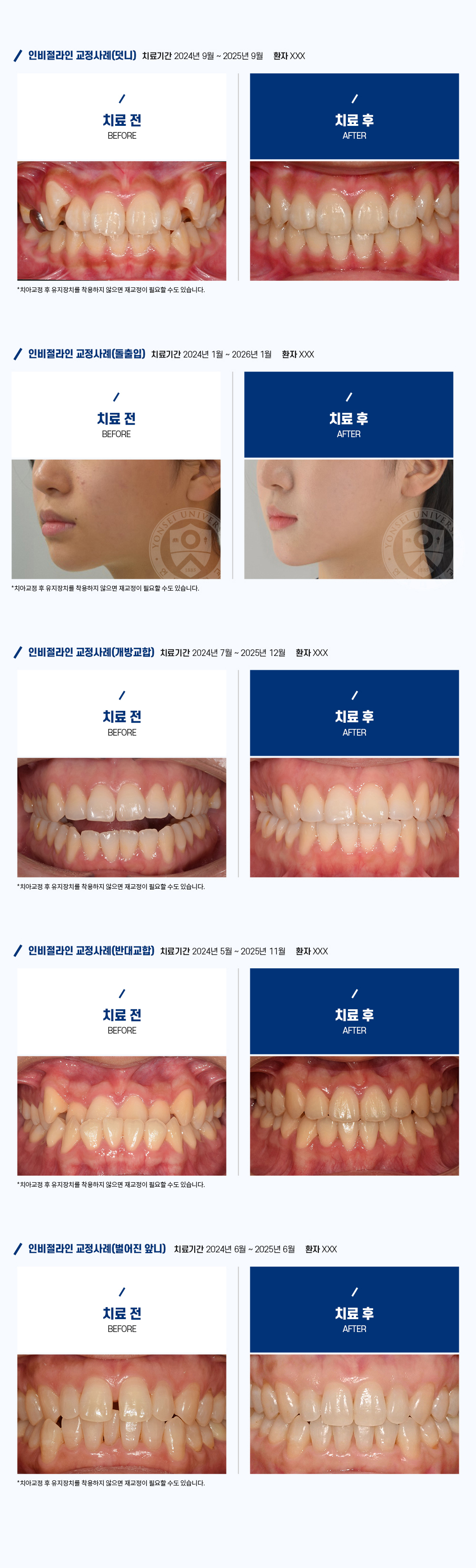 인비절라인 교정 사례 - 덧니, 돌출입, 개방교합, 반대교합, 벌어진 앞니 치료 전후 비교