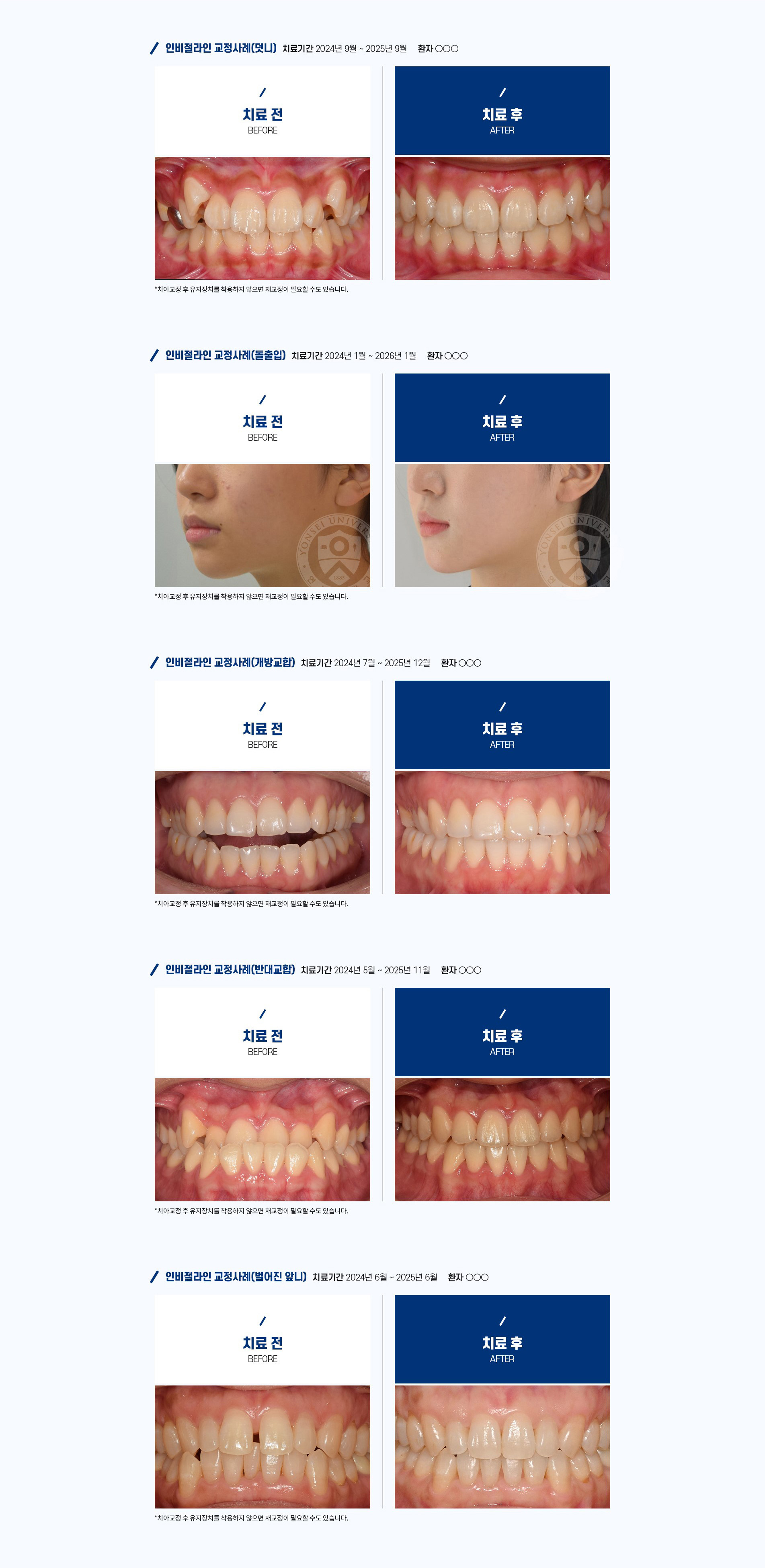 인비절라인 교정 사례 - 덧니, 돌출입, 개방교합, 반대교합, 벌어진 앞니 치료 전후 비교